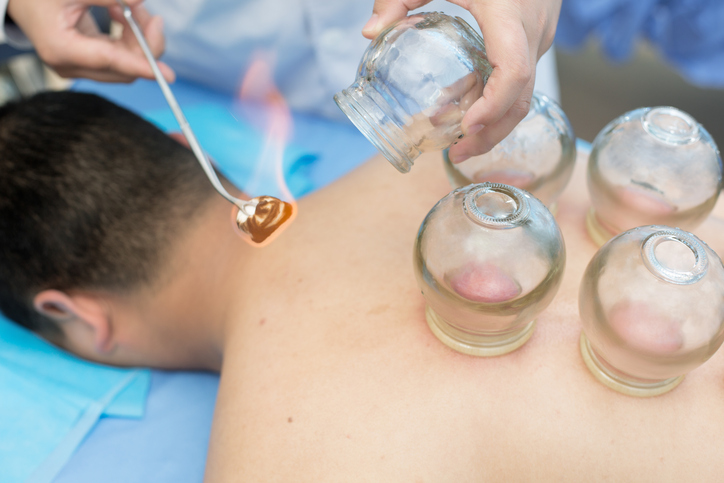 Person lying on stomach receives cupping treatment from massage therapist